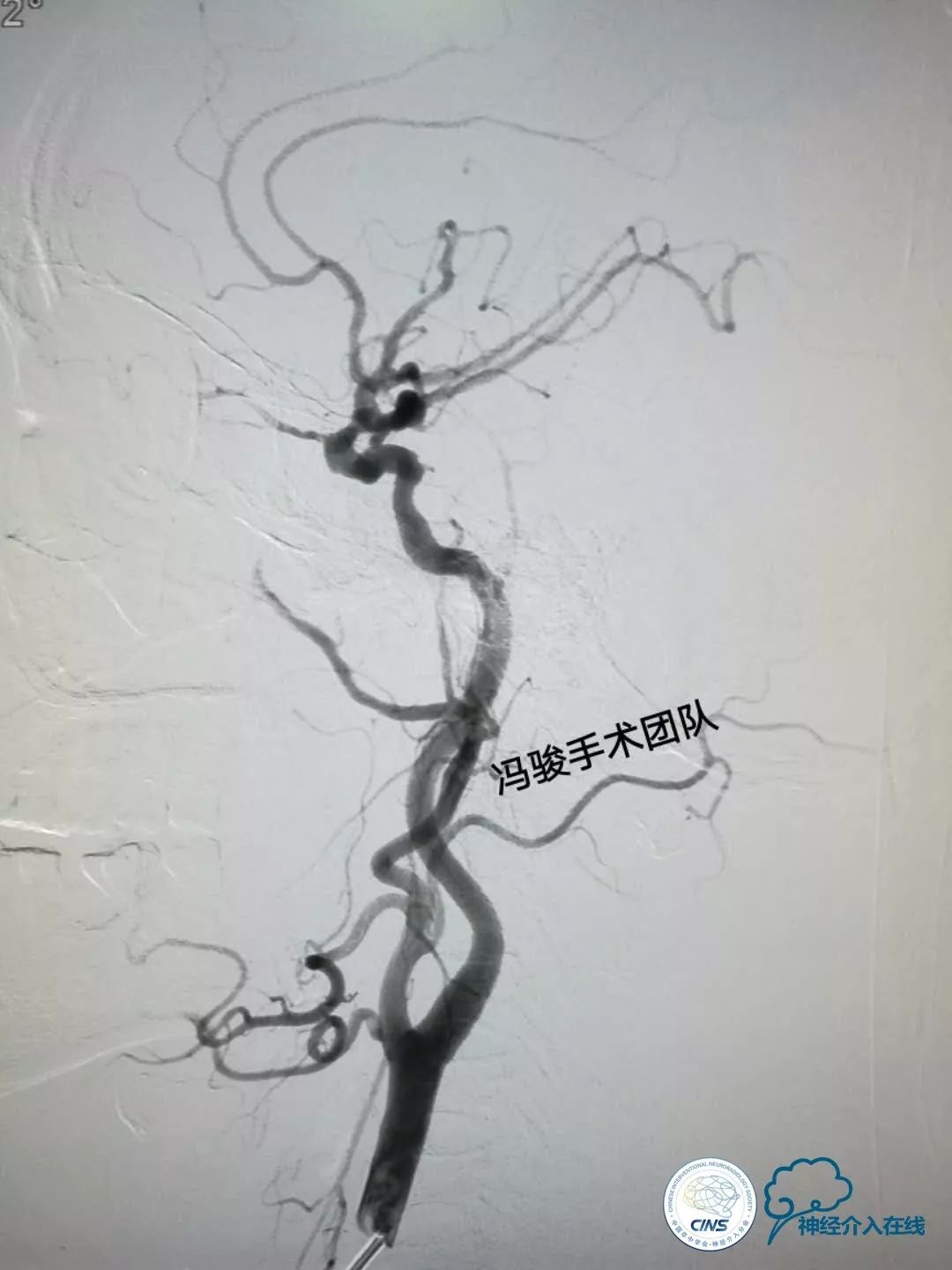 天新福—百家百言｜一例孤独椎动脉V4段并PICA重度狭窄支架手术及1年随访
