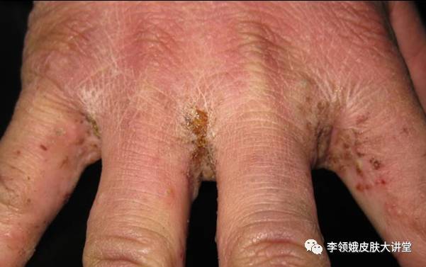 怎样判定身上痒是疥疮,怀疑是疥疮怎么治