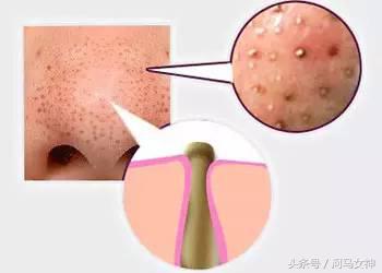 抗痘填坑,抗痘期间忌口大全