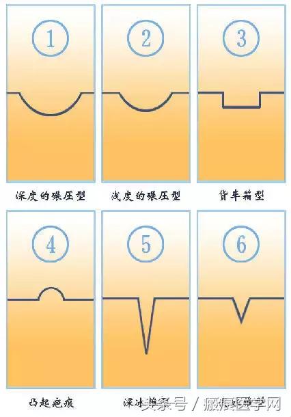 十几年痘坑痘印怎么祛除,十几年的水痘坑怎么填平