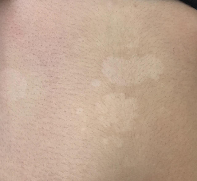 女生肚子上出现斑点,肚子上有一块白白的汗斑怎么治