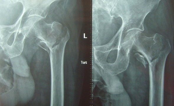 股骨粗隆间骨折的护理问题及措施,股骨粗隆骨折临床指南