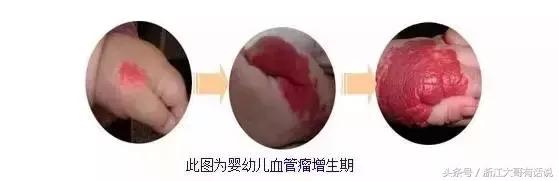 婴儿血管瘤对孩子有什么危害,宝宝血管瘤危害