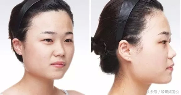 打完苹果肌脸僵了,打完苹果肌肿一块硬硬的