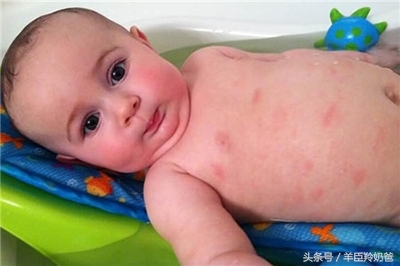 奶粉过敏的宝宝就不能吃奶粉了吗,宝宝喝奶粉过敏的原因及解决方法