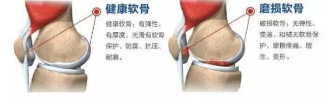 退化性关节炎护膝方法,退化性关节炎饮食方法
