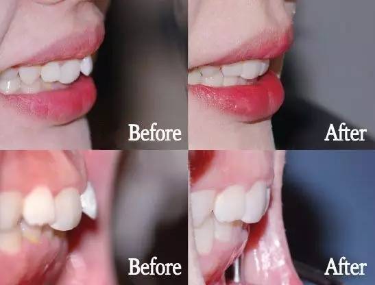 牙齿矫正钢牙套多少钱,淄博牙齿矫正多少钱