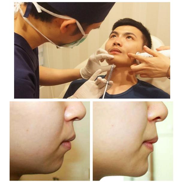 玻尿酸美容的正确方法,玻尿酸又称午餐式美容