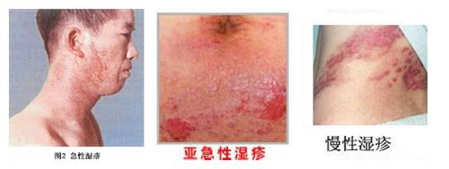 全世界得湿疹的人有多少,湿疹几乎人人都得过