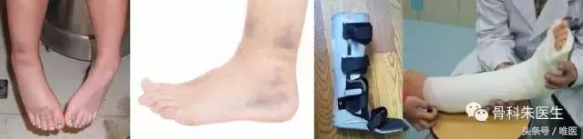 骨科医生脚崴了用什么药,一个真正的医生谈脚踝扭伤处理