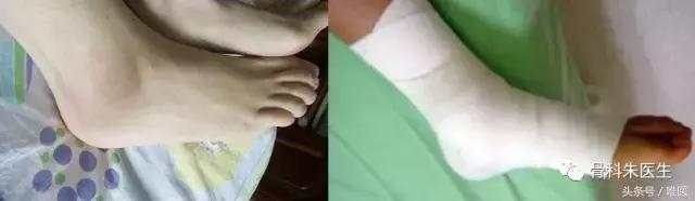 骨科医生脚崴了用什么药,一个真正的医生谈脚踝扭伤处理