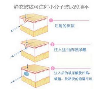 玻尿酸美容的正确方法,玻尿酸又称午餐式美容