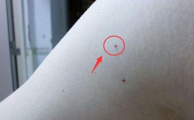 皮肤长小红痣不痛不痒是什么原因,身上长了好多小红痣是什么症状