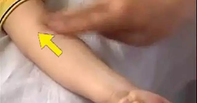 孩子湿疹怕用药有激素,不妨试试这几个穴位