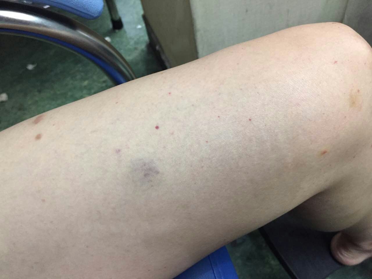 乏力、双下肢不痛痒的“出血点”，竟是“累出来”的“血液病”？