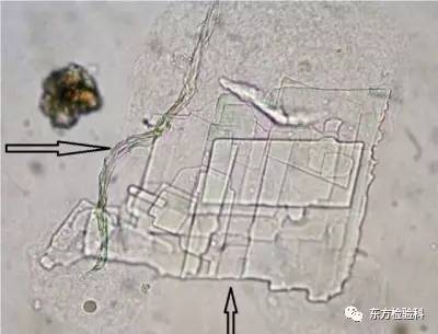 尿中结晶达到多少就是结石了,尿结晶数高是病吗