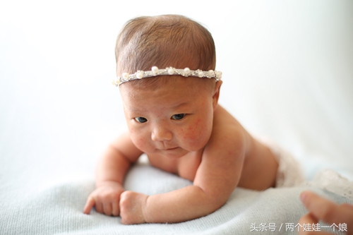 新生儿头皮血肿正确的处理方式,新生儿头皮血肿处理方法