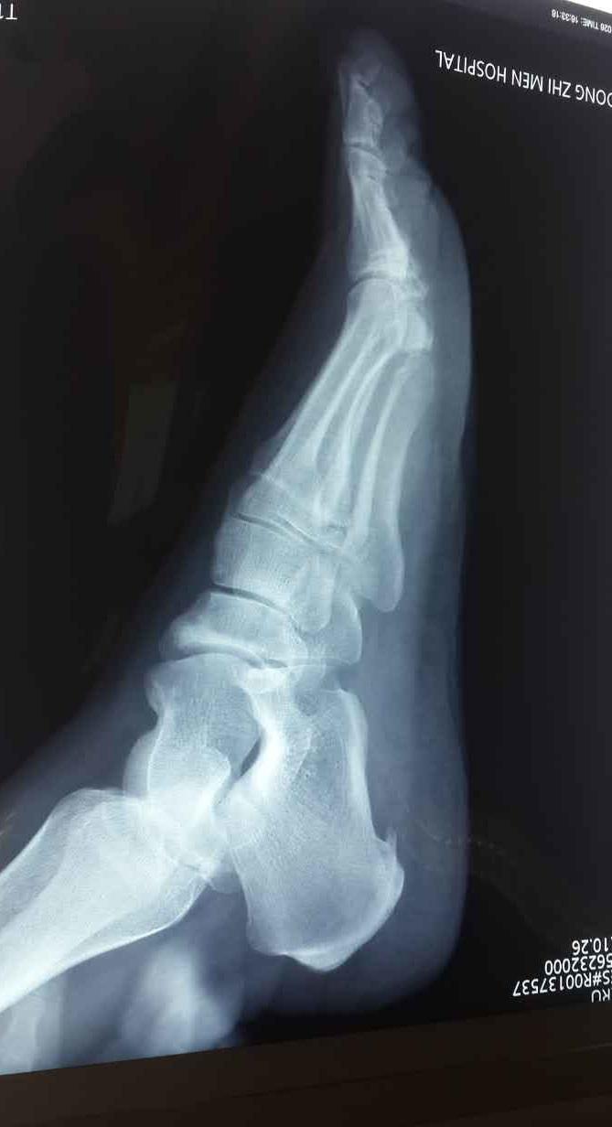 足跟突然疼痛是什么原因引起,为什么早上起来足跟痛