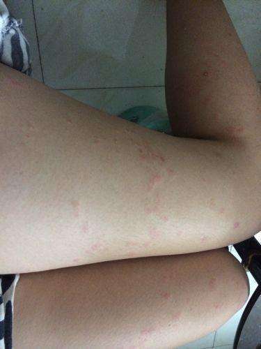 湿疹特别痒只能靠打针该怎么办,湿疹太痒了偏方