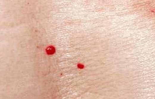 身上长了这种痣竟是肝硬化前兆,皮肤上长红痣要当心是肝病的征兆
