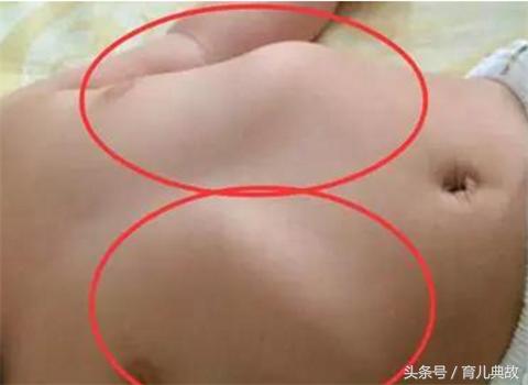 十一个月宝宝肋骨外翻是缺钙吗,怎样区分遗传还是缺钙性肋骨外翻