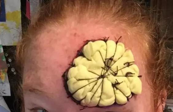 澳女脸上长了个黑包，竟是皮肤癌！只能用腿部皮肤移植到额头！