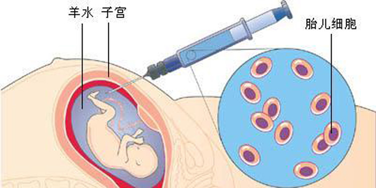 羊水穿刺针头扎到胎儿会怎么样,羊水穿刺会扎到大脑吗