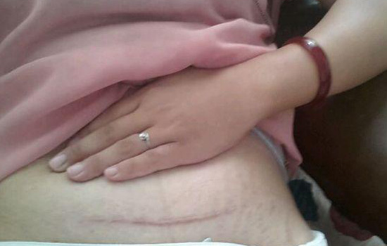 剖腹产伤口多久才可以洗澡,剖腹产后15天洗澡后伤口更痛