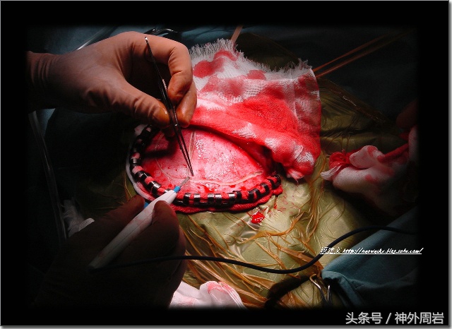 烟雾病脑内出血,烟雾病脑室出血死亡率