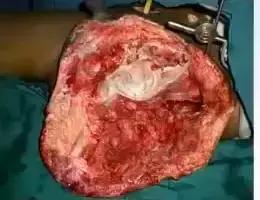 如何促进感染创面的愈合,创面感染原因