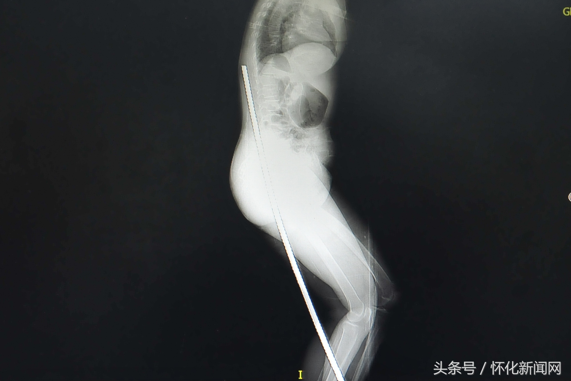 怀化第一人民医院车祸事故,怀化第一人民医院的医疗事故