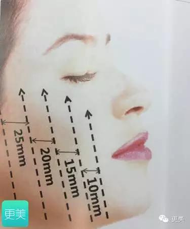 埋线美容线和不吸收线有什么区别,医院埋线和美容院埋线有什么差别