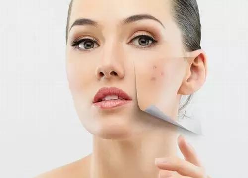 抖音往年那些事,痘印问题该不该去医院