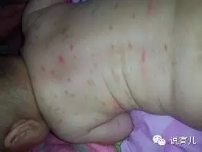 宝宝玩耍突然晕厥,婴儿一去公园就起疹子