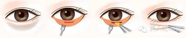 分不清是哪种黑眼圈,分不清楚是眼袋还是黑眼圈