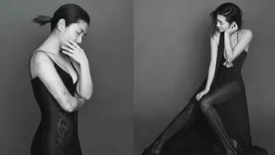 selina烧伤修复图片,selina疤痕修复