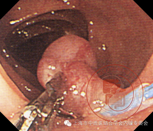 内镜套扎是什么,内镜套扎器械