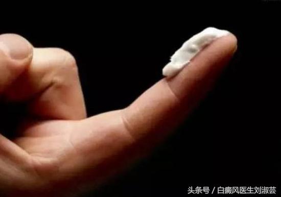 白癜风医生给出3点用药建议,白癜风医生开的激素药