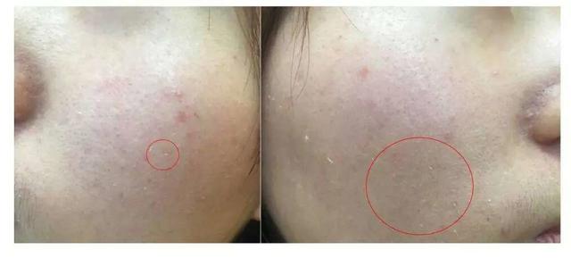 激素依赖性皮炎修复期什么样,激素依赖性皮炎怎么算彻底修复好