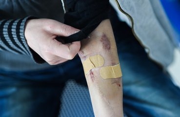 18岁得了尿毒症还要坚持治疗吗,13岁得肾炎是怎么引起的