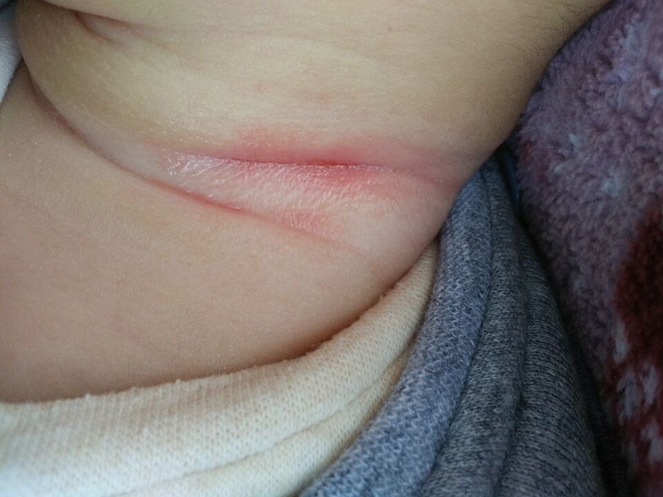 夏天宝宝的脖子很容易淹，千万不要再擦干粉，这几个小妙招很管用