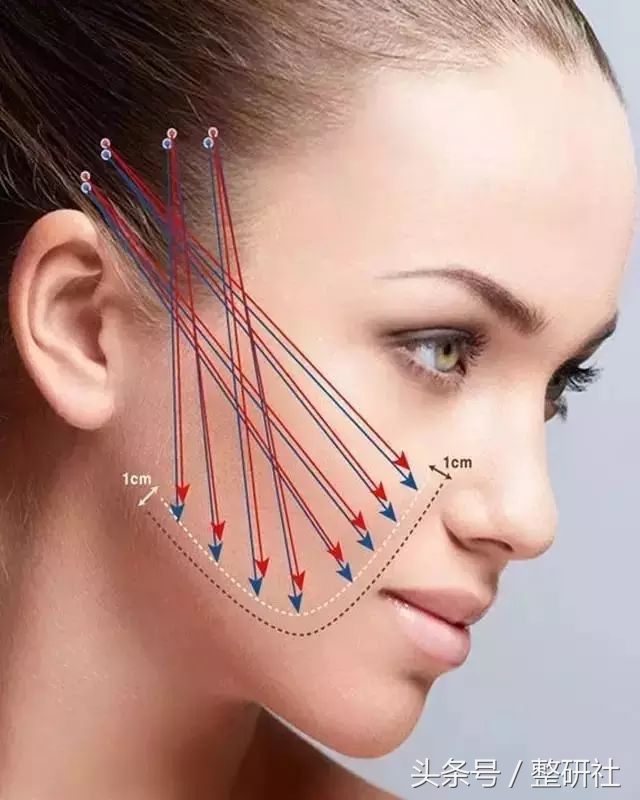 无创提升苹果肌,无创和微创技术