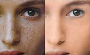 什么是激光祛斑怎么治疗,什么是激光祛斑后的反黑