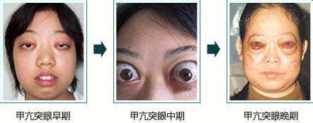 甲亢患者的眼部护理,甲亢病人护理诊断及护理措施