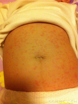 婴幼儿发热如何应对,婴幼儿发热手脚冰凉