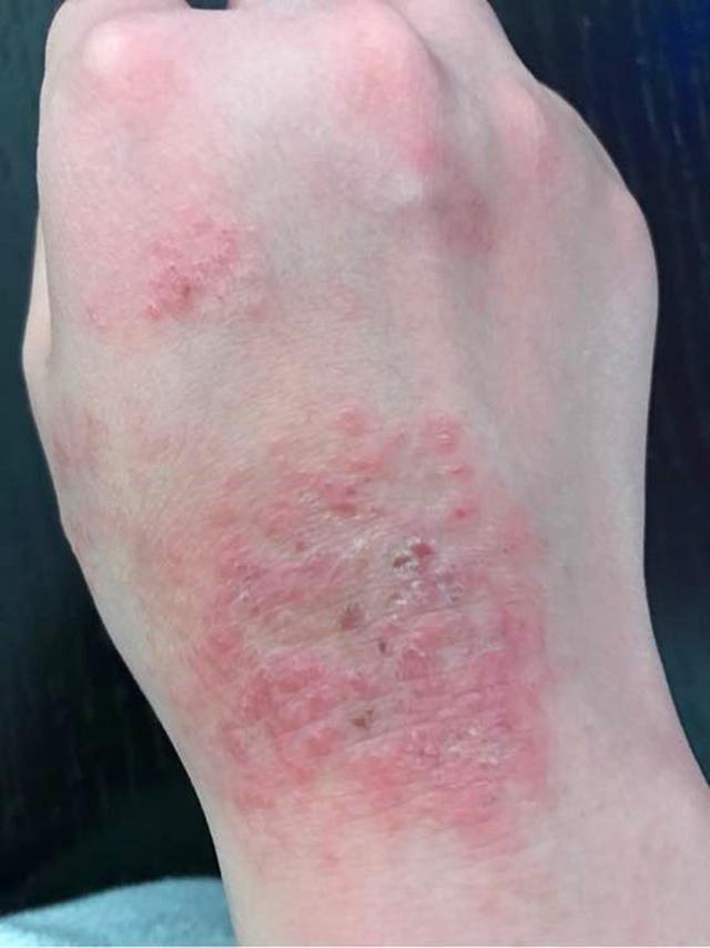 长湿疹怎么一挠一个包,长了湿疹全身痒的不行有什么办法