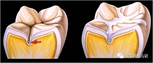 儿童涂氟前需要做口腔内窥镜吗,小孩牙齿涂氟好还是做窝沟封闭好