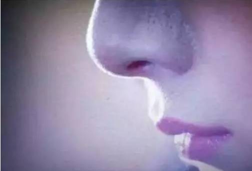 粉刺黑头去除最快方法,黑头虫怎么去除最快方法