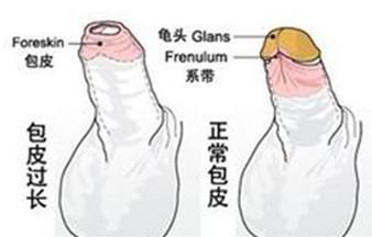 包皮割还是不割比较好,以前的人割不割包皮