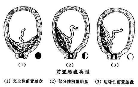 边缘性前置胎盘见红影响胎儿吗,孕晚期前置胎盘为什么出血